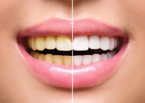 Teeth Whitening Las Vegas