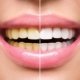 Teeth Whitening Las Vegas